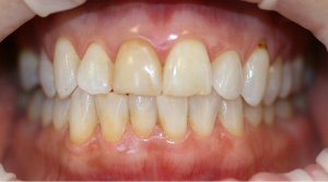 998_Marie_Carone_Implant_Veneer_smile_makeover