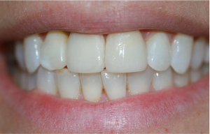 Someone with a straight, white smile that had a dental implant procedure recently